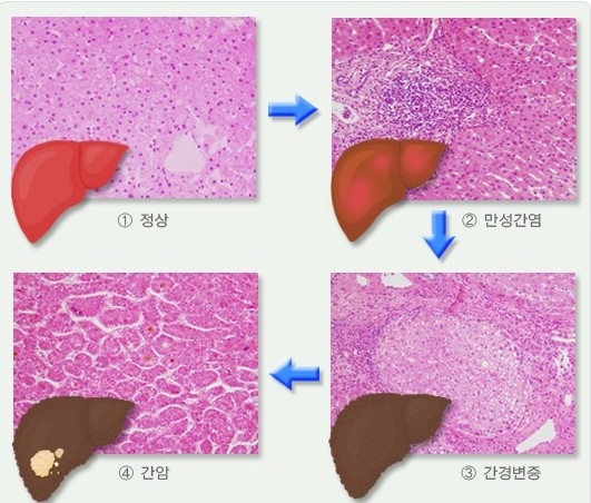 B형 간염