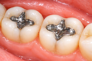 유해중금속 수은 함유 치과 아말감 폐기물 여전히 관리 사각지대