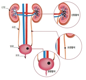 여름 ‘땀 뻘뻘’ 후 가을 ‘옆구리 통증’ 온다면…요로결석 아닐까?