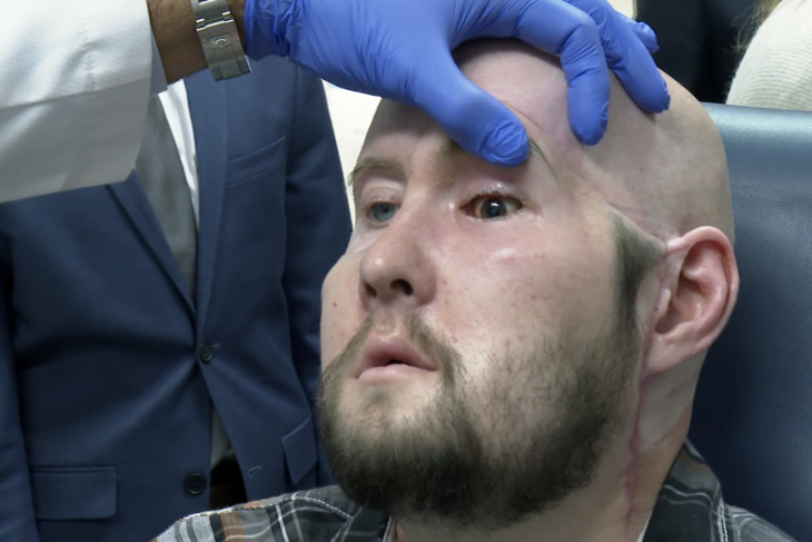 Whole Eye Transplant