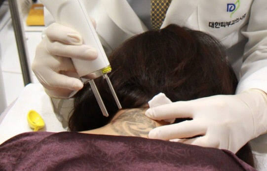문신을 지우는 데 시용되는 레이저 시술의 일종. 사진=임이석테마피부과