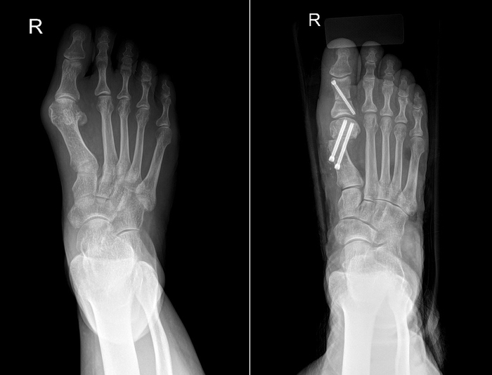 무지외반증 수술 전(왼쪽)과 수술 후 엑스레이 영상. 사진=바른세상병원