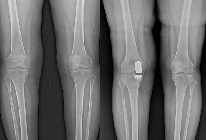 무릎인공관절 수술