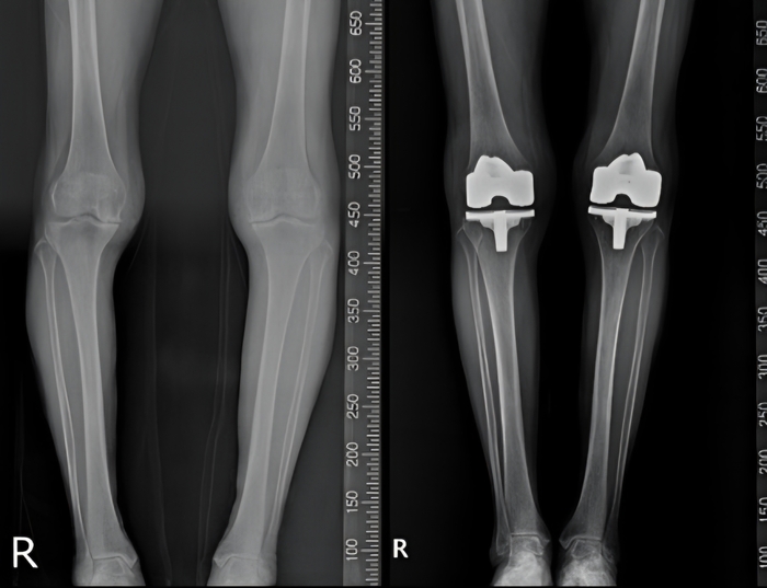 연세사랑병원 인공관절 수술