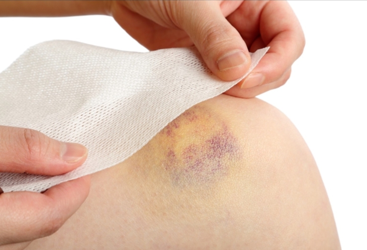 타박상이나 염좌 증상 완화에 효과가 있는 파스. 사진=바른세상병원 블로그