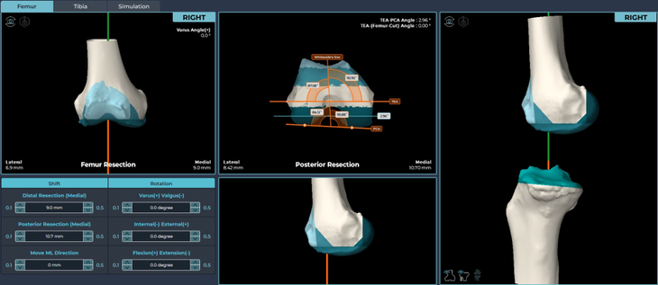 AI를 활용해 무릎 구조를 3D로 정밀하게 구현하는 OnKnee-U(TKR)