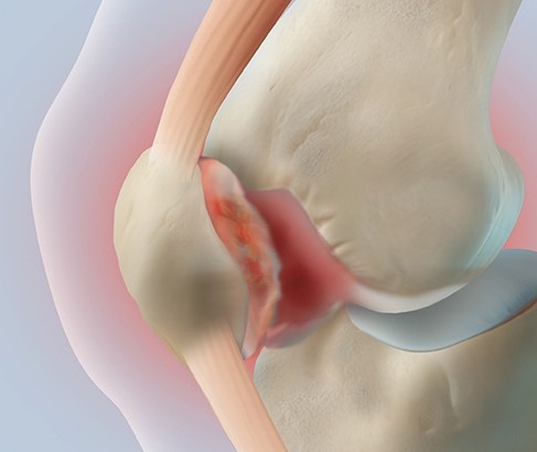 연골연화증...염증, 말랑말랑...연세사랑병원