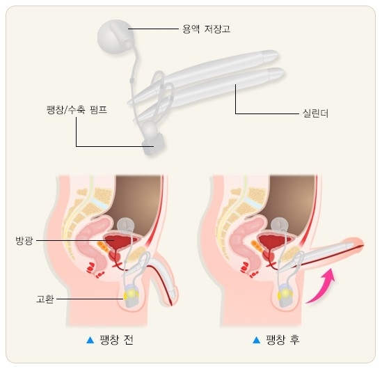 질병관리청 국가건강정보포털 음경보형물