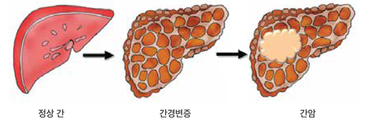 간암