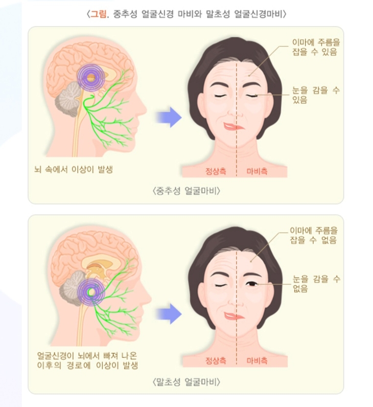 안면신경마비