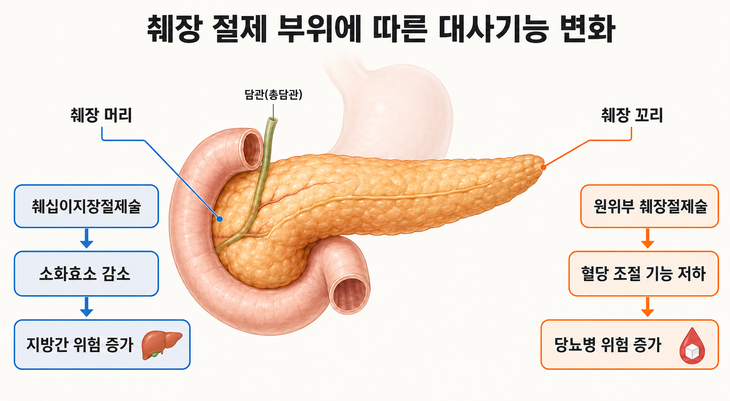 [그림] 췌장 절제 부위에 따른 대사기능 변화 개념도