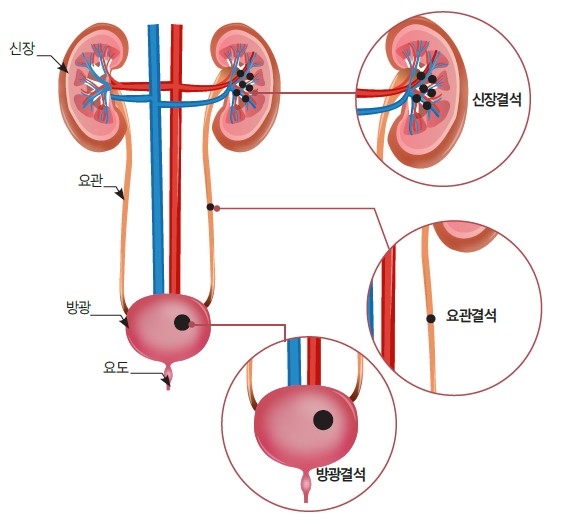 분당서울대병원 요로결석이 발생할 수 있는 위치