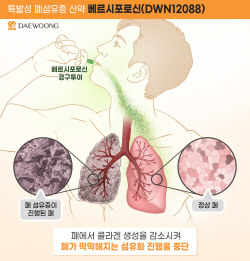 대웅제약 특발성 폐섬유증 신약, 美 이어 유럽서 ‘희귀의약품’ 지정