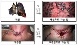 [건강e+ 삶의 질] ‘폐암 시한폭탄’ 흡연, 아직도 끊지 않았나요