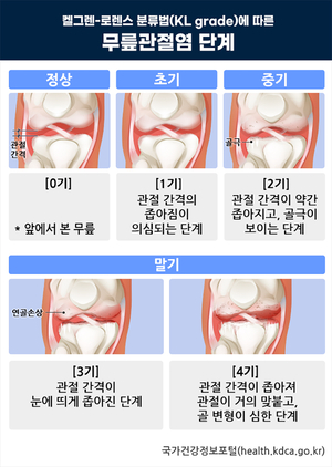 [기고] 노인 우울증과 자살률 높이는 관절염