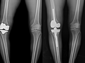 연세사랑병원, 무릎 인공관절 재수술 1000례 달성