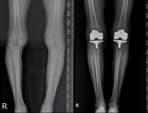 연세사랑병원, 말기 무릎관절염 수술에 인공지능 접목