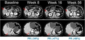 한미약품, 흑색종 신약 ‘벨바라페닙’ 임상 2상 환자 투약 시작