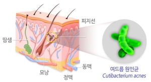 [클릭! 3분 건강] 짜고 달고 기름진 음식, 여드름 유발하는 ‘독(毒)’