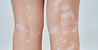 피부에 얼룩덜룩 ‘하얀 반점’ 커진다면…‘백반증’ 의심해야