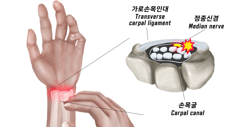 손목이 저려서 밤잠까지 설친다면…‘손목터널증후군’ 의심을